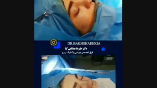 نمونه کار جراحی بینی گوشتی