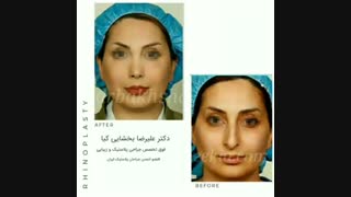 تغییر فوق العاده چهره بعد از عمل بینی