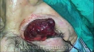 جراحی تومور بزرگ کاسه چشم