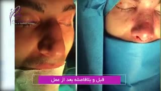 فیلم جراحی زیبایی رینوپلاستی بلیچینگ