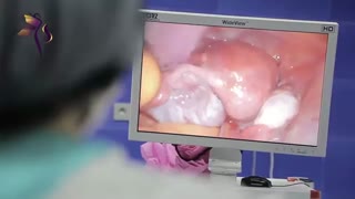 لاپاراسکوپی اندومتریوز