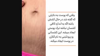 استریا چیست و چطور می توان آن را درمان کرد؟