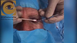 فیلم عمل جراحی تومور بدخیم پلک