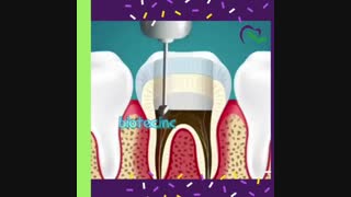 فیلم واقعی عصب کشی دندان کودکان