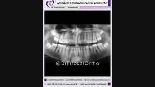 اصلاح ناهنجاری جلوزدگی فک پایین همراه با فواصل دندانی | دکتر فاضل فیروزی