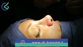 فیلم جراحی بینی استخوانی قوزدار