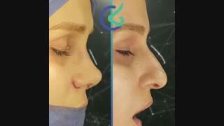نمونه جراحی بینی غضروفی افتاده