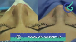 فیلم جراحی بینی طبیعی زنانه توسط دکتر علی بصام