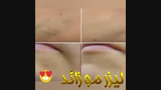 لیزر موهای زائد با تجربه ایی بدون درد و بی حسی