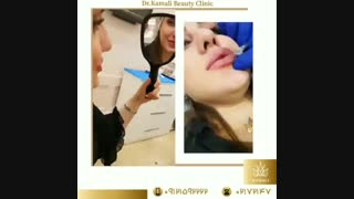 تزریق ژل لب با متد روسی