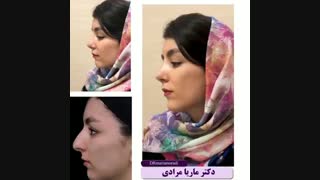 فیلم واقعی جراحی بینی طبیعی