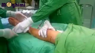 فیلم جراحی آرتریت سپتیک زانو (عفونت مفصلی زانو) در پسر 14 ساله