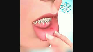 استفاده از موم برای جلوگیری از زخم شدن دهان