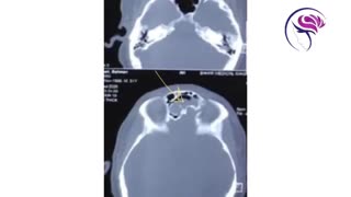 برای تشخیص موکوسل سینوس این فیلم را از دست ندهید!