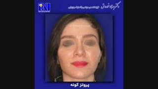 پروتز گونه