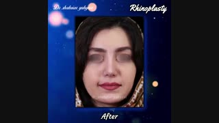 فیلم جراحی بینی