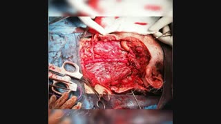 سرطان expleomorph پاروتید وسیع