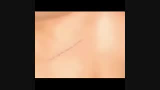 جراحی کیسه صفرا به دو روش جراحی باز و لاپاراسکوپی