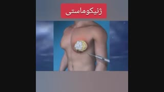 جراحی ژنیکوماستی