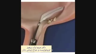 عمل TUL شکستن سنگِ گیر کرده در حالب ( لوله ی متصل کننده ی کلیه به مثانه)