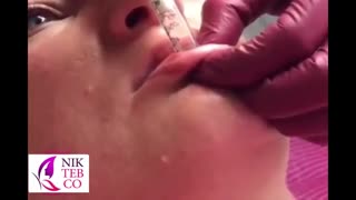 آموزش تزریق ژل با دستگاه بدون سوزن هیالورون پن به لب دیگران