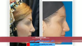 فیلم واقعی عمل زیبایی بینی