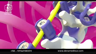 علاج تشوهات العمود الفقری عند الاطفال