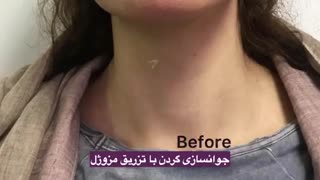 جوانسازی گردن با تزریق مزوژل