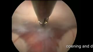 فیلم عمل اندوسکوپی مغزی