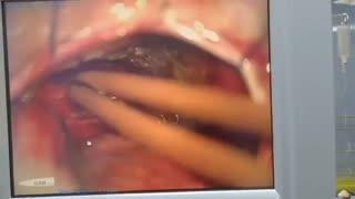 تومور مننژیوم چادرینه یا تنتوریوم