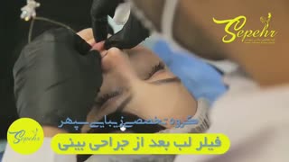 فیلم برجسته سازی و فرم دهی لب با تزریق ژل