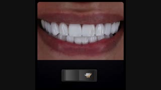 اصلاح طرح لبخند پس از برداشتن کامپوزیت‌های قدیمی | دکتر حامد صالحی