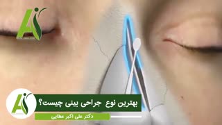 بهترین نوع جراحی بینی
