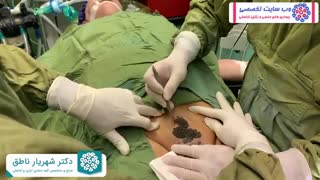 درمان زگیل تناسلی