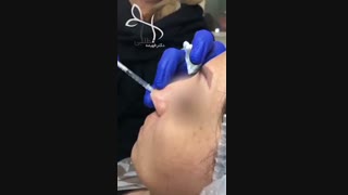 فیلم تزریق فیلر به بینی