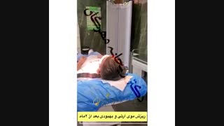 ریزش مو ارثی و بهبودی بعد از دو ماه