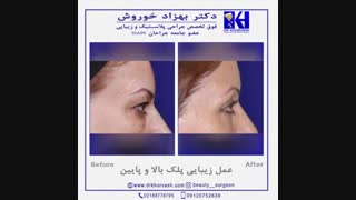 جراحی زیبایی پلک