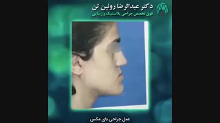 عمل جراحی بای مکس توسط دکتر عبدالرضا روئین تن فوق تخصص جراحی پلاستیک