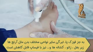 موثرترین روش های رفع تیرگی آرنج، زانو و قوزک پا