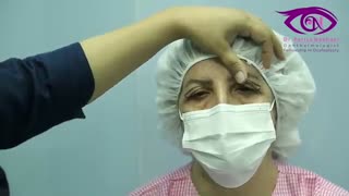 فیلم واقعی جراحی بلفاروپلاستی