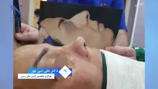 فیلم نتیجه جراحی زیبایی بینی