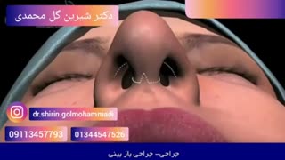 فیلم انیمیشن جراحی زیبایی بینی