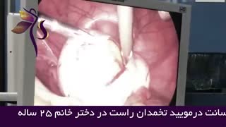 لاپاراسکوپی کیست تخمدان بزرگ