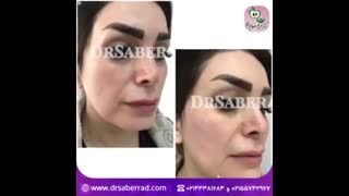 تزریق مید فیس