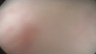 درمان تنگی مجرا در شخص بیمار