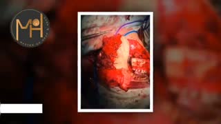 فیلم جراحی توده زبان