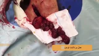 فیلم عمل توده گردنی