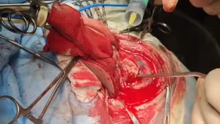 فیلم عمل جراحی تومور مغزی در بیماری که با تشنج یا صرعهای مزمن آمدند