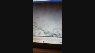 کویل گذاری داخل آنوریسم مغزی