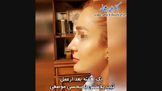 عمل تیپ پلاستی با بی حسی موضعی